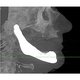 Jaw Implant