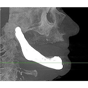 Jaw Implant