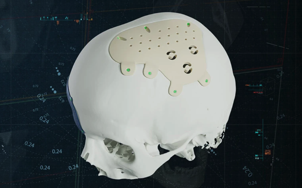Materialise now offers PEEK cranio-maxillofacial implants alongside titanium, with a 72-hour product...