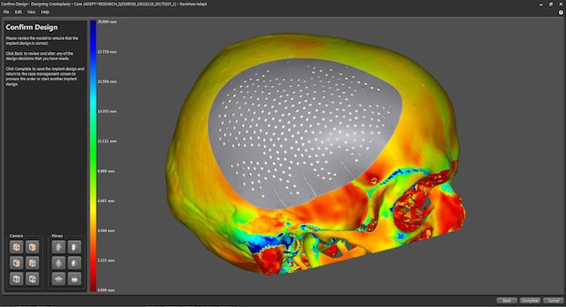 A cranial plate model in Renishaw's ADEPT software