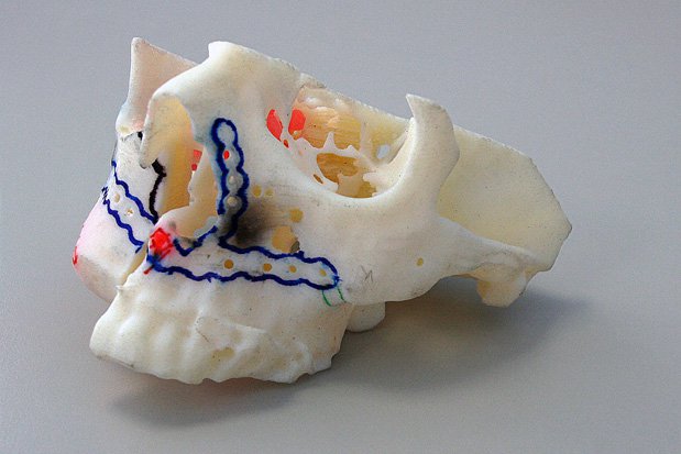 Stratasys medical model Queen Liz Hosp Stratasys medical model Queen Liz Hosp