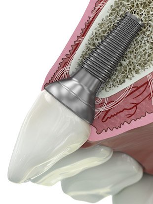 GE Add dental abutment GE Add dental abutment