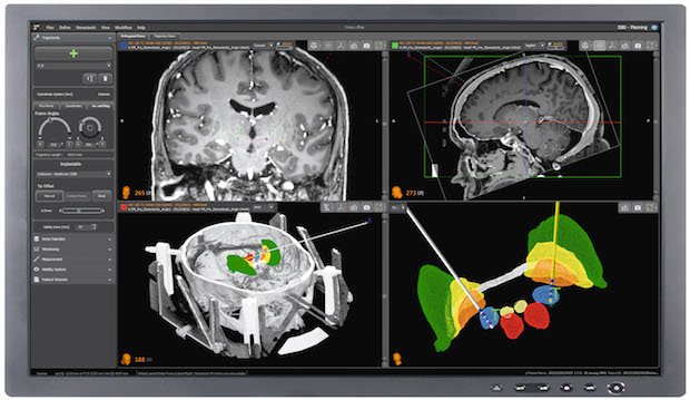 Image 2 Renishaw_neuroinspire_surgical_planning_software.jpg Image 2 Renishaw_neuroinspire_surgical_planning_software.jpg