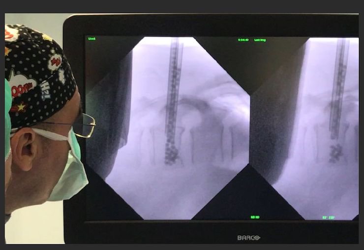 Kyphoplasty procedure. Kyphoplasty procedure.