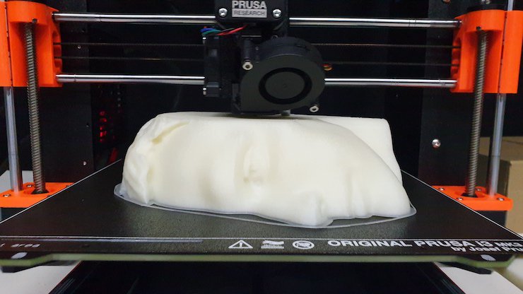 Facial nerve paralysis Facial nerve paralysis