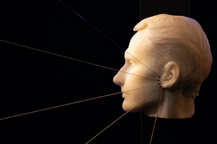 Facial nerve harp. Facial nerve harp.