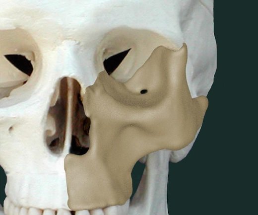 OPM_maxilla reconstruction.jpg