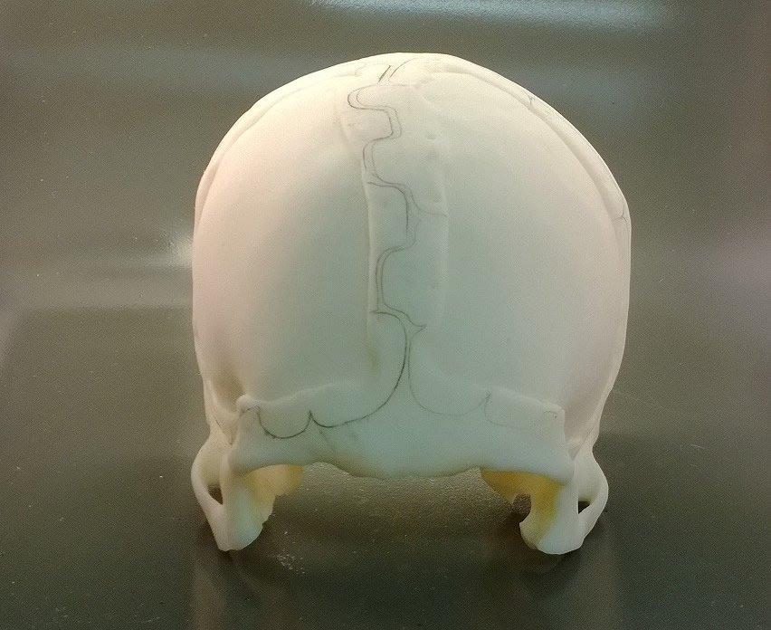 Cranioplasty without implant Cranioplasty without implant
