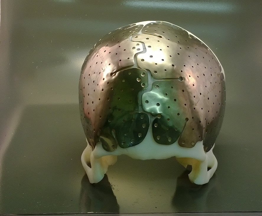 Cranioplasty with implant Cranioplasty with implant