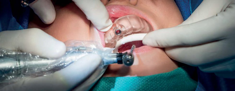 Formlabs’ dental surgical guide in surgery Formlabs’ dental surgical guide in surgery