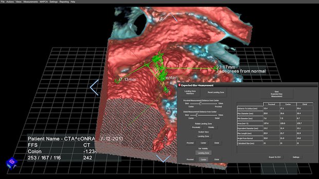 EchoPixel software medical EchoPixel software medical