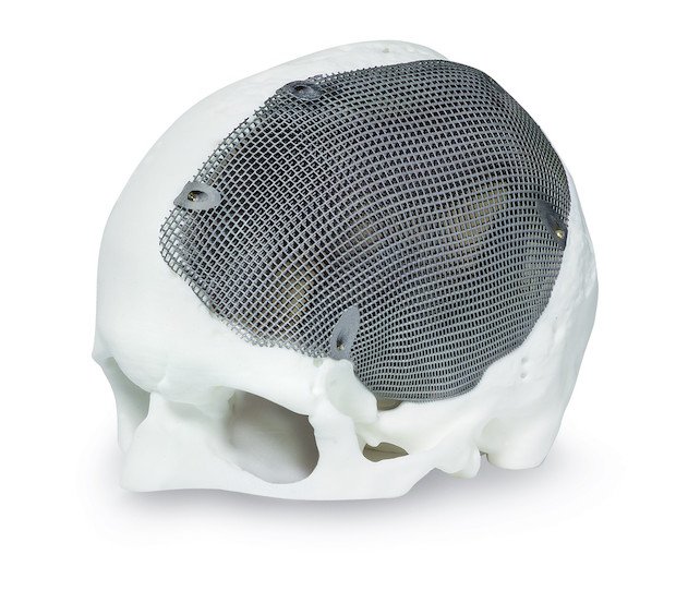 Concept Laser medical implant