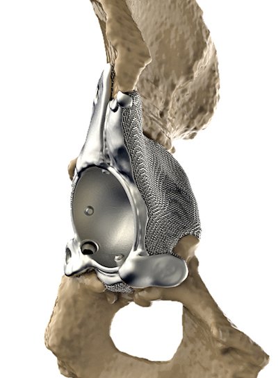 Nikon Metrology ortho hip implant                The patient-specific acetabular hip implant in place.