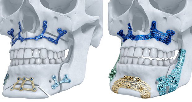 3D printed titanium maxillofacial implants receive clearance for the U.S. market. - Picasa