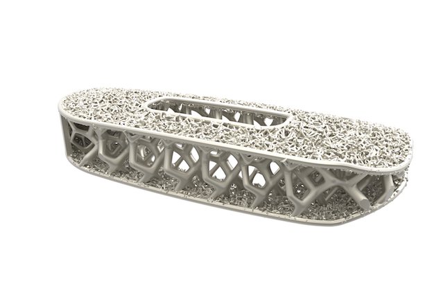 NuVasive Modulus XLIF