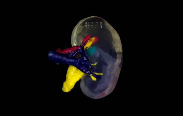 axial 3D kidney mode      3D model of kidney used as a preoperative planning tool. - axial3D