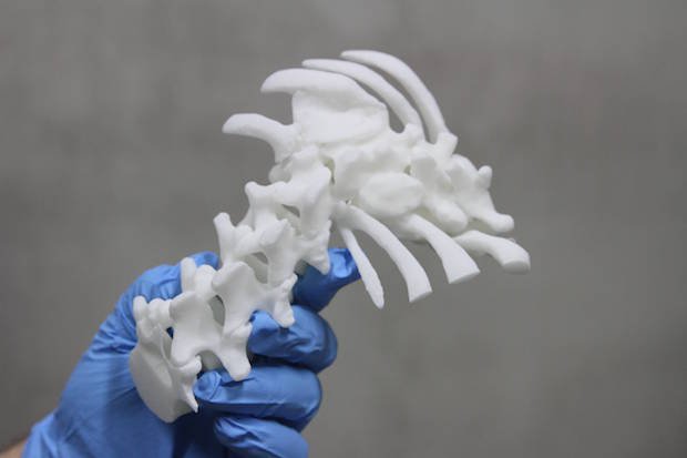 3D LifePrints spine-in-hand      3D model printed prior to a kyphoscolisys procedure. - 3D LifePrints