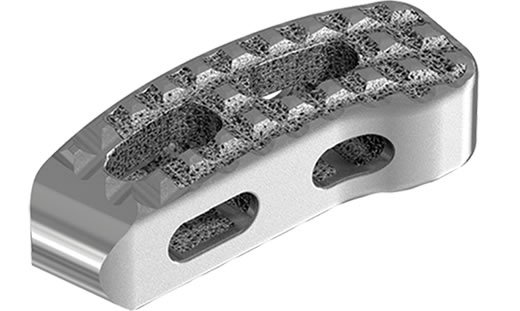 Curved Posterior Lumbar Cage Stryker      Tritanium TL Curved Posterior Lumbar Cage. - Stryker