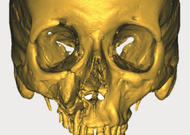 Pre-operative situation showing patient with large cancerous tumour.
