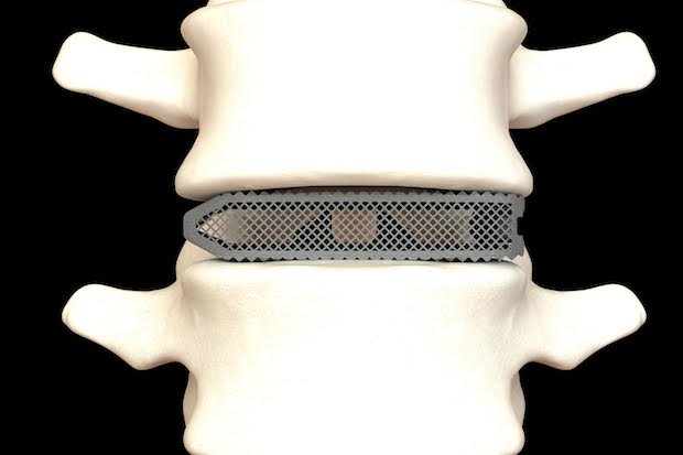 Aries Osseus      An Aries interbody fusion device additively manufactured by Osseus. - Osseus Fusion Systems
