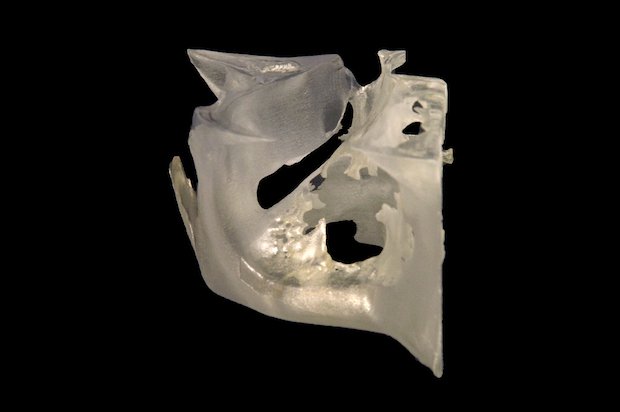 Stratasys Patient specific 3D printed surgical guide      Patient-specific anatomical guide 3D printed on the Stratasys Objet30 Prime 3D Printer in MED610. - Stratasys