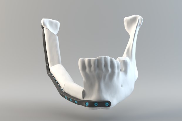Render of a lower jaw implant.      Render of a lower jaw implant. - Quentin Schneider, 3D modeling lab, CHU de Quebec.