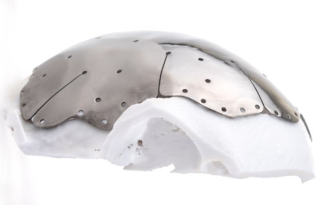 Maxillofacial implant      Custom maxillofacial implant additively manufactured with Renishaw technology. - Renishaw