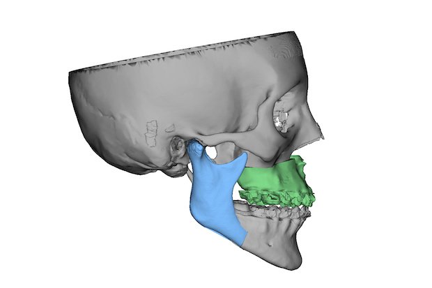 3D Systems software showing the final positions in a virtual surgery      3D Systems software showing the final positions in a virtual surgery. - 3D Systems