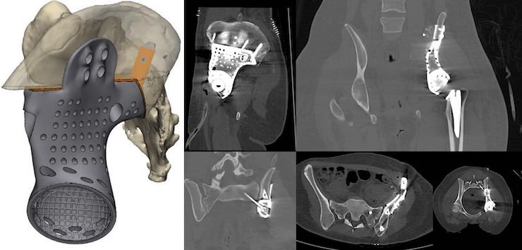 MT Ortho      Oncological custom made device. - MT Ortho