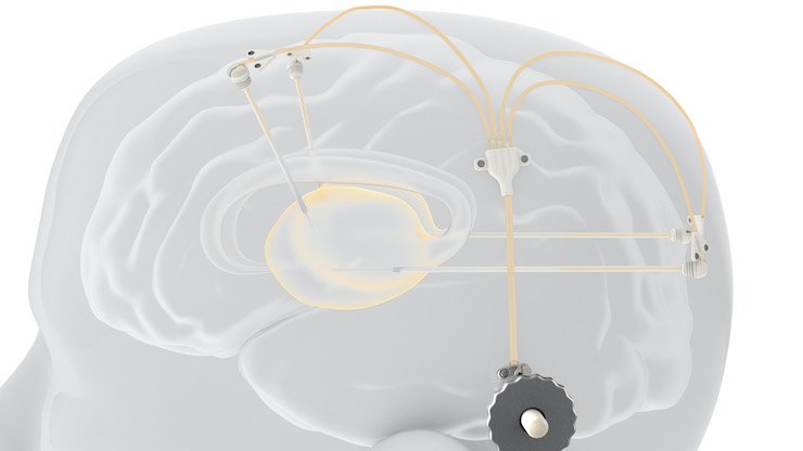 Renishaw's neuroinfuse device.      Renishaw's neuroinfuse drug delivery device.