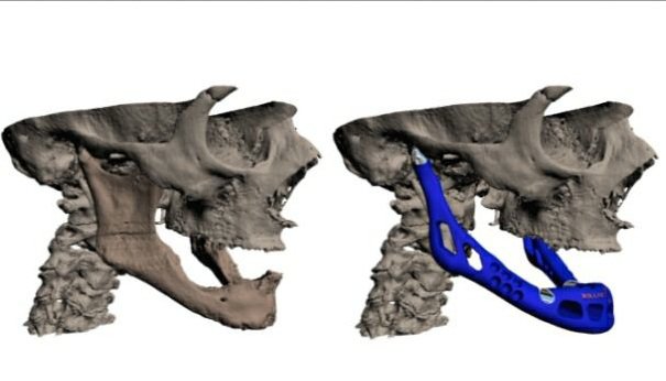 LayerWise Jaw      LayerWise's expertise in medical applications is well known. The company used additive manufacturing to produce the world’s first patient-specific total lower jaw implan...