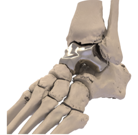 Additive Orthopaedics