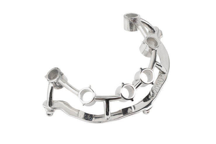 3D printed and polished osteotomy guide for dental implants.