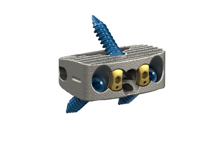 Monterey AL Interbody System - Stryker