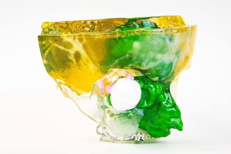 Patient-specific 3D printed anatomic model of a large tumour of the right nasal cavity