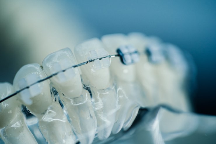 Lightforce Orthodontics to advance production of 3D printed braces system with 80 million USD funding