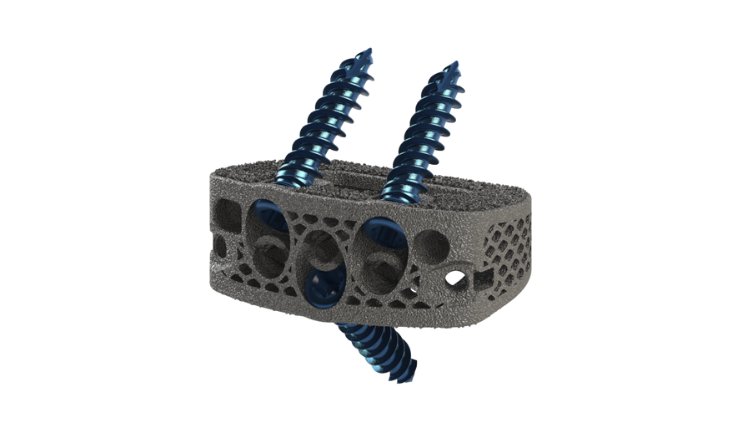 DeGen ALIF edit - 1 - DeGen Medical