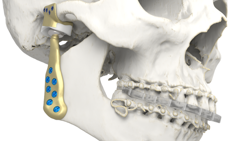Personalized TMJ implant rendering - Materialise