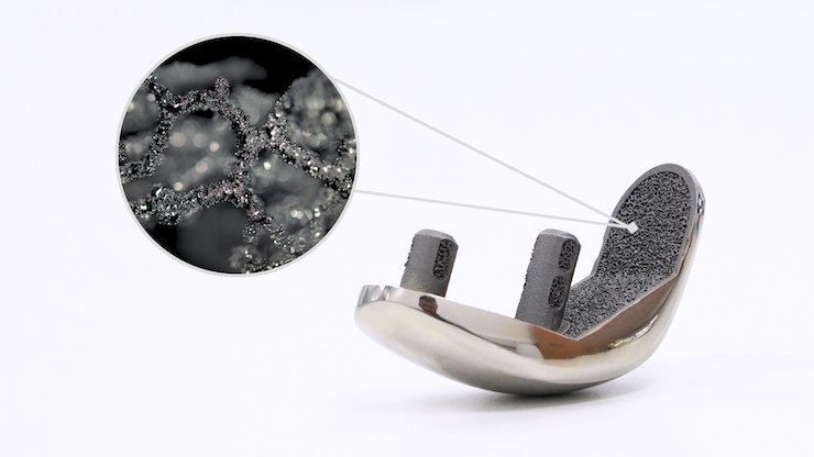 Biofuse Photos - 19      Partial Knee Implant with Biofuse 3D-Printed Lattice Structure manufactured using Laser-Powder-Bed-Fusion technology in Ti64 Grade 23. - Croom Medical
