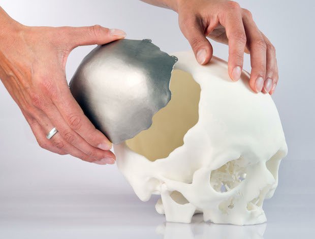 Cranial implants made with EOS technology.