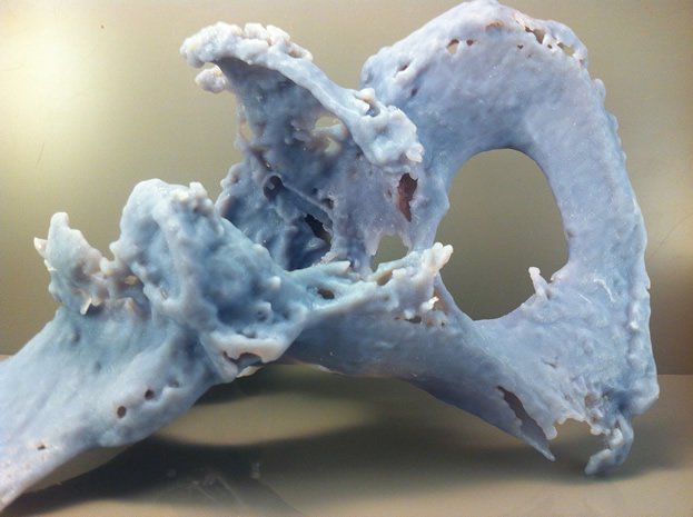 Hip Revision Model      Hip Revision Model