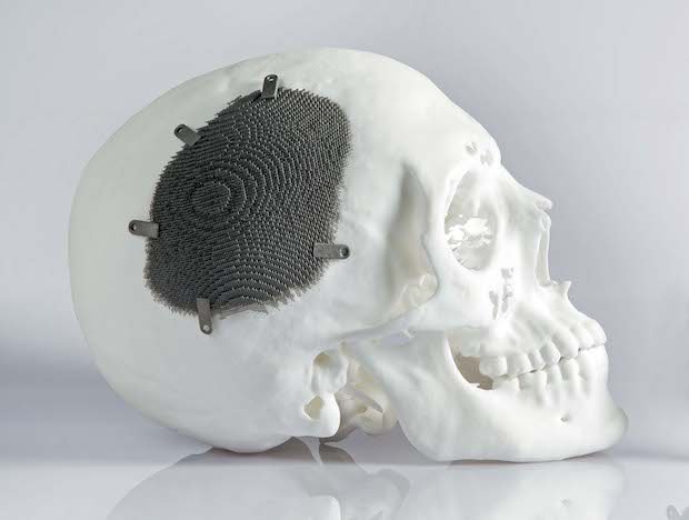 Additive manufactured implant made of a biocompatible titanium alloy.