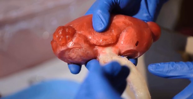 3D printed kidney      An artificial kidney with hydrogel injected into it to give it a lifelike feel. - URMC/ YouTube