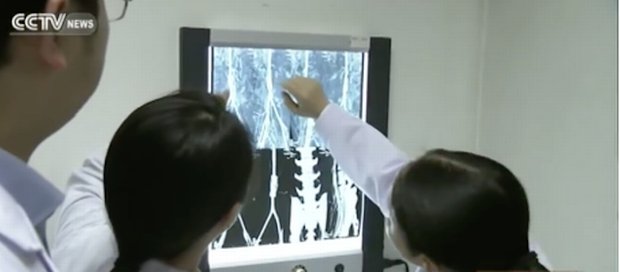 Chinese blood vessel      Chinese scientists examine the results during testing of 30 monkeys to create blood vessels - CCTV News