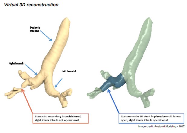 Toulouse doctors airway stents 3D reconstruction      This latest development offers hope to patients who suffer with Tracheobronchitis and other infections that affect the windpipe and/or...