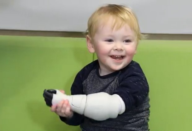 Sol with his new prosthetic arm.