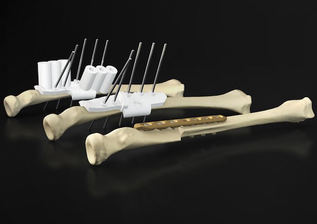 Materialise Osteotomy Guides      Materialise's 3D-printed osteotomy guides which will assist orthopaedic surgeons in understanding and executing even the most complex surgeries.