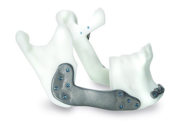 Concept Laser medical implants      Additively manufactured implant, made with Concept Laser's M2 cusin machine