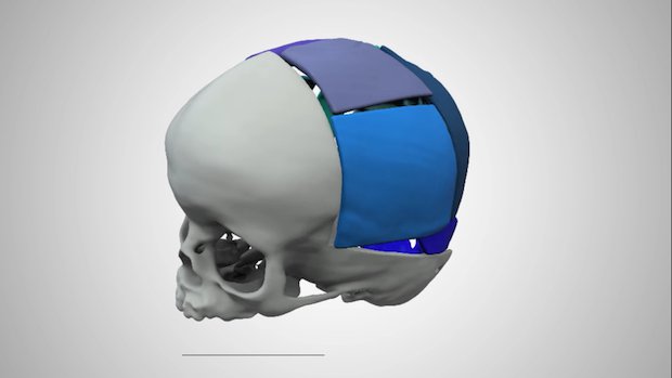 3D Systems cranial surgery