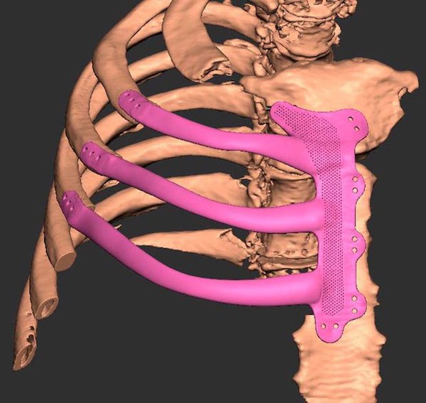 CT Scan Renishaw Rib implant 1